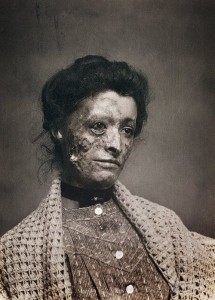 Female victim of burns acid